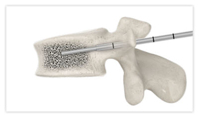 Step 2: Insert the guidewire to the midpoint of the vertebral body, then remove the access cannula
