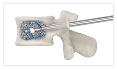 SpineJack system inserted into the fractured vertebra to restore its shape, filling the cavity with bone cement