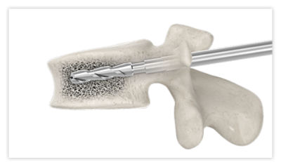 Step 3: Following the path of the guidewire, advance the reamer until it is entirely within the vertebral body