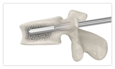 Step 4: Insert the template to clean the implant site and verify the length of the implant
