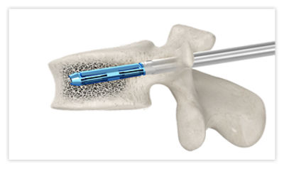 Step 5: Place the SpineJack implant into the vertebral body