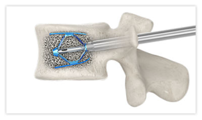Step 6: Expand the SpineJack implant to reduce the fracture and restore the anatomy