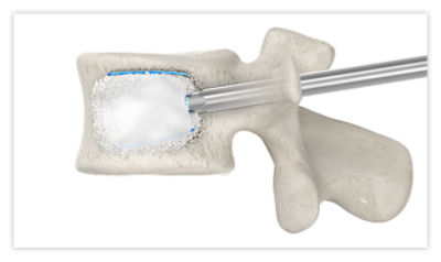Step 8: Inject cement to stabilize the fracture