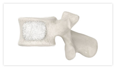 Vertebra fully stabilized with bone cement, following the completion of the SpineJack procedure