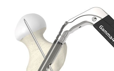 Gamma4 Hip Fracture Nailing System | Stryker