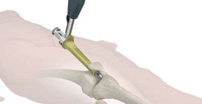 t2-alpha-tibia-spi