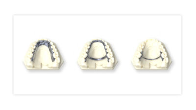 ti-palatal-splints-thumbnail