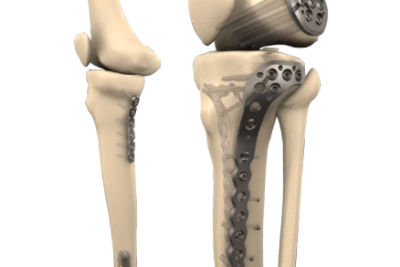 Tibia and femur