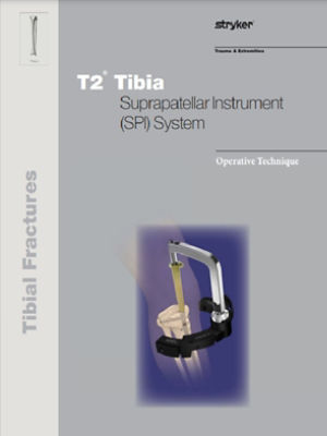 T2 Tibia SPI System Operative Technique