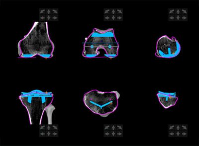 total knee_plan