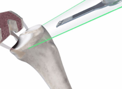total_knee_can