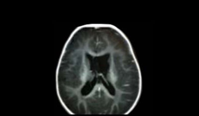 tumor-and-brain-biopsy-clinical-impact_post-op