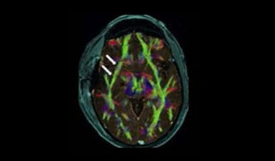 tumor-and-brain-biopsy-clinical-impact_post-op_MR-DTI