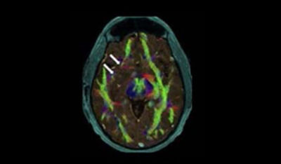 tumor-and-brain-biopsy-clinical-impact_pre-op_MR-DTI