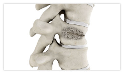 A spine showing a fractured vertebra before vertebroplasty begins