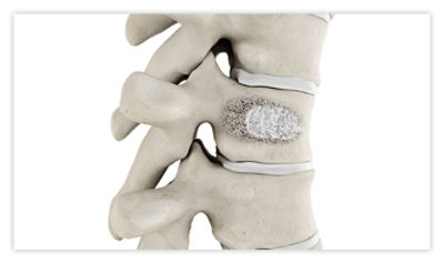 A treated vertebrae after vertebroplasty treatment