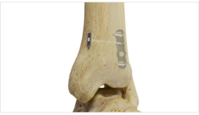 Synchfix EVT - Syndesmotic fixation device - Soft Tissue