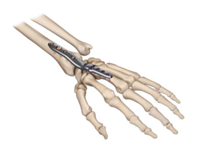 VariAX 2 Wrist Fusion